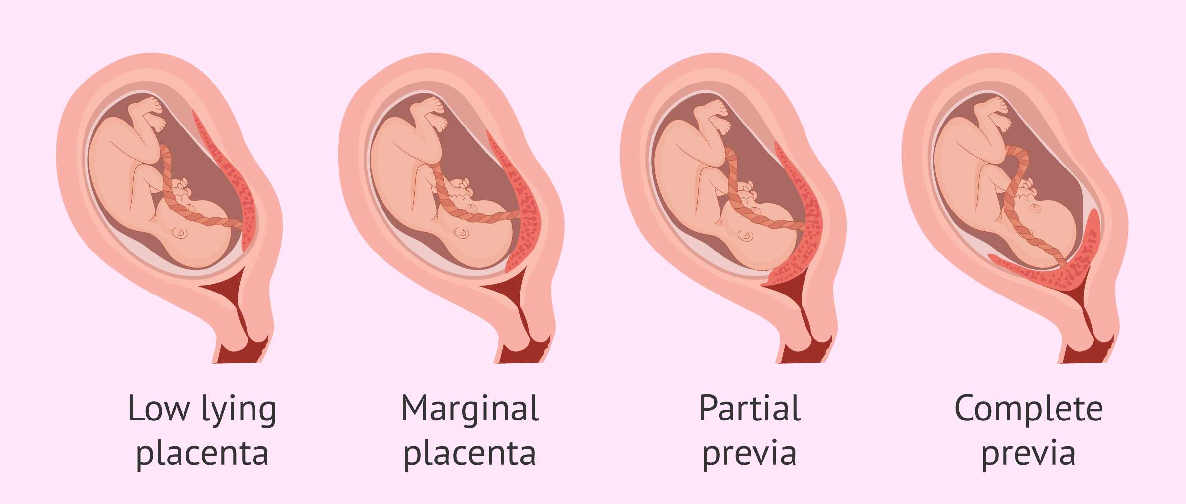 Read more about the article Understanding Placenta Previa: Types, Complications, and Best Practices during Pregnancy